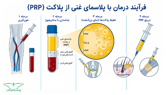 نحوه انجام پی ار پی