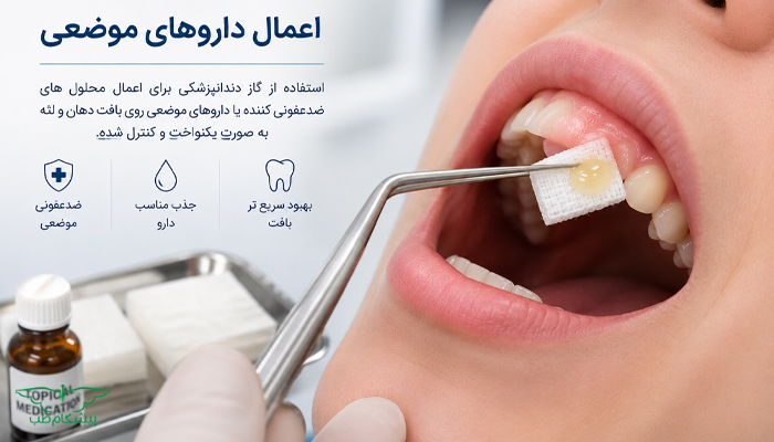گاز دندانپزشکی برای اعمال داروهای موضعی
