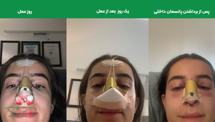 مراقبت های پس از عمل جراحی بینی