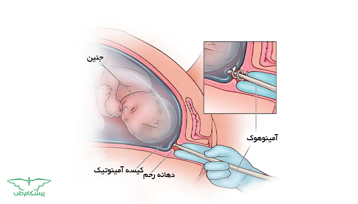 آمینوتومی