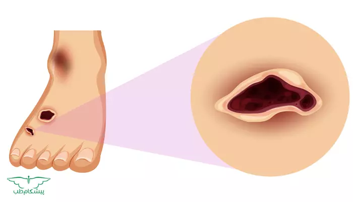پانسمان زخم دیابتی