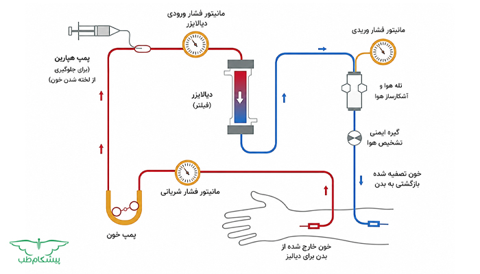 مراحل انجام همودیالیز